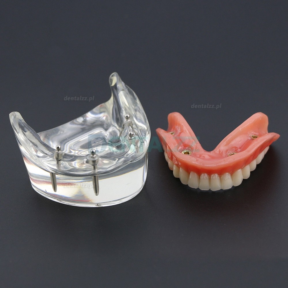 Model badania dentystycznego zębów dolnych 6002 02 Implanty Overdenture Inferior 4