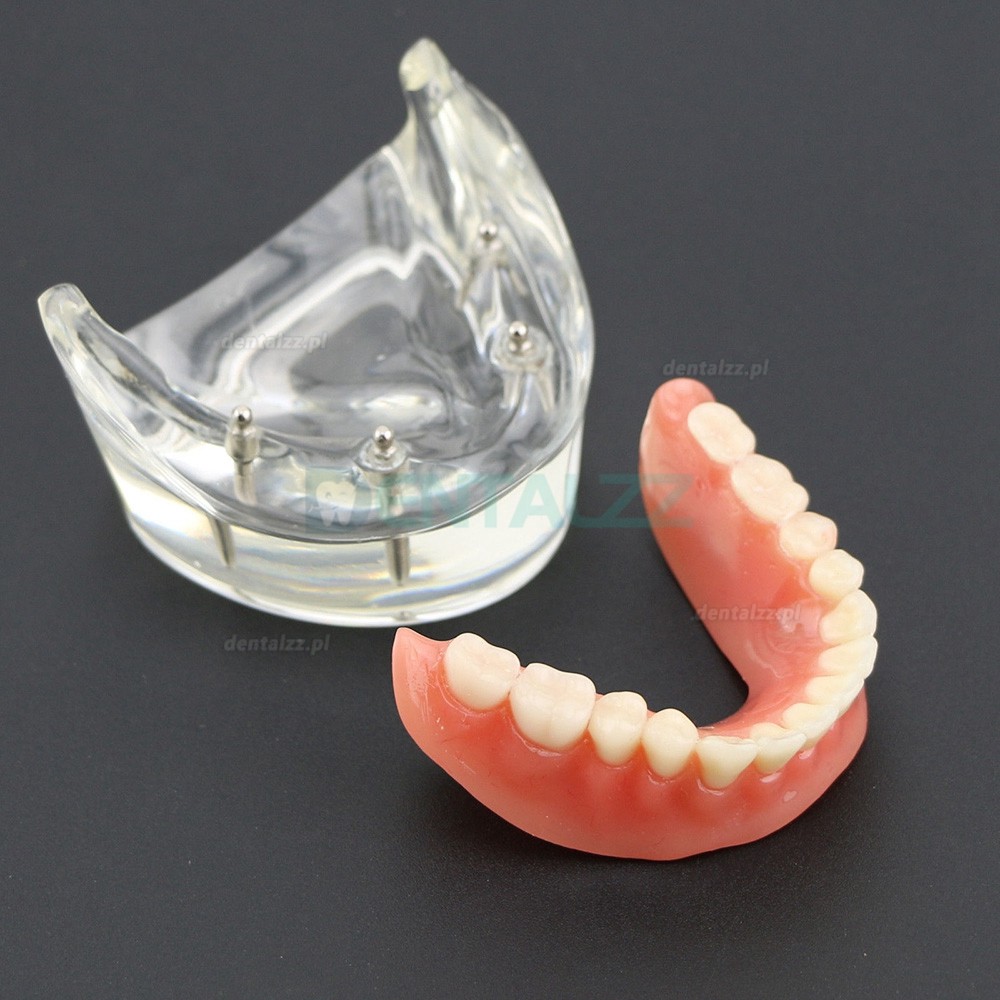 Model badania dentystycznego zębów dolnych 6002 02 Implanty Overdenture Inferior 4