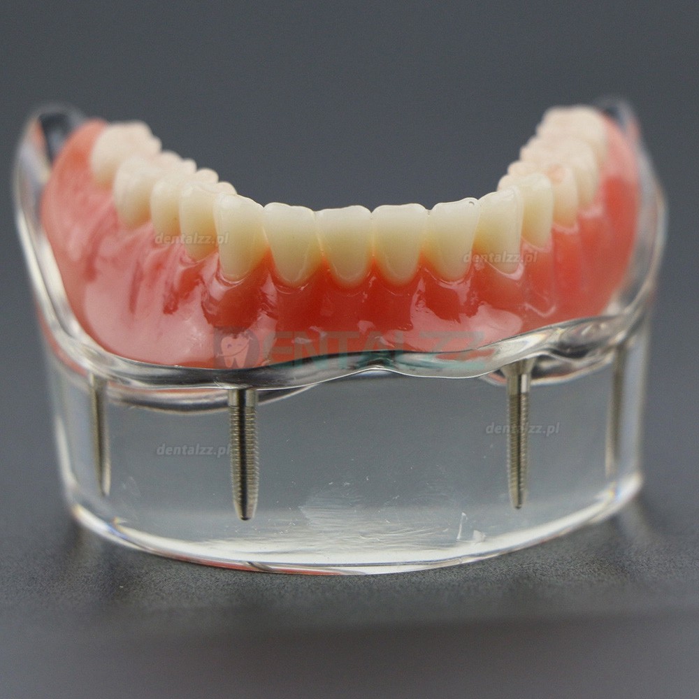 Model badania dentystycznego zębów dolnych 6002 02 Implanty Overdenture Inferior 4