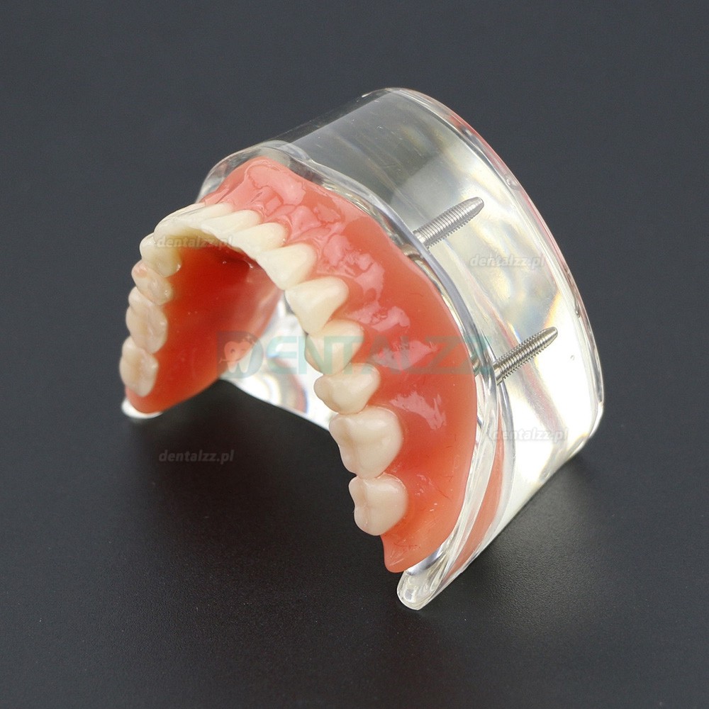 Model badania dentystycznego zębów dolnych 6002 02 Implanty Overdenture Inferior 4