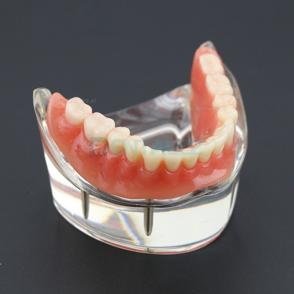 Model badania dentystycznego zębów dolnych 6002 02 Implanty Overdenture Inferior 4