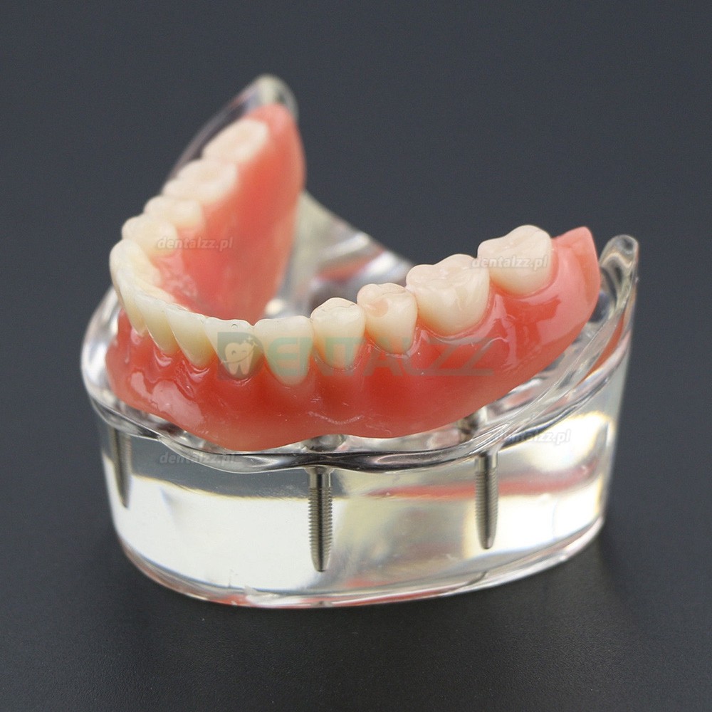 Model badania dentystycznego zębów dolnych 6002 02 Implanty Overdenture Inferior 4