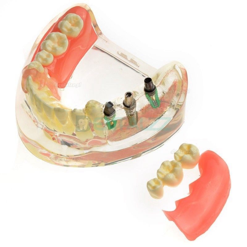 Odbudowa brakujących zębów trzonowych na modelach dentystycznych M-6006