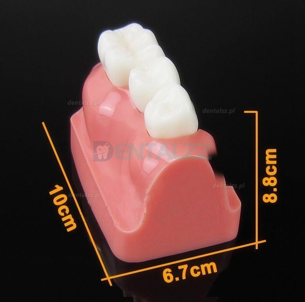 Analiza modelu implantu dentystycznego M2017
