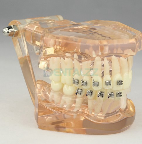 Model dentystyczny ortodontyczny z zamkami ceramicznymi M3009