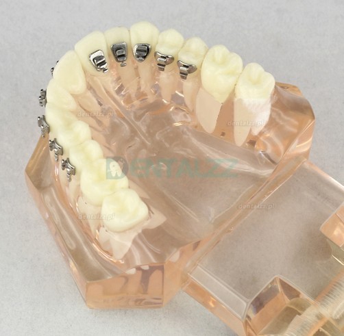 Model dentystyczny ortodontyczny z zamkami ceramicznymi M3009