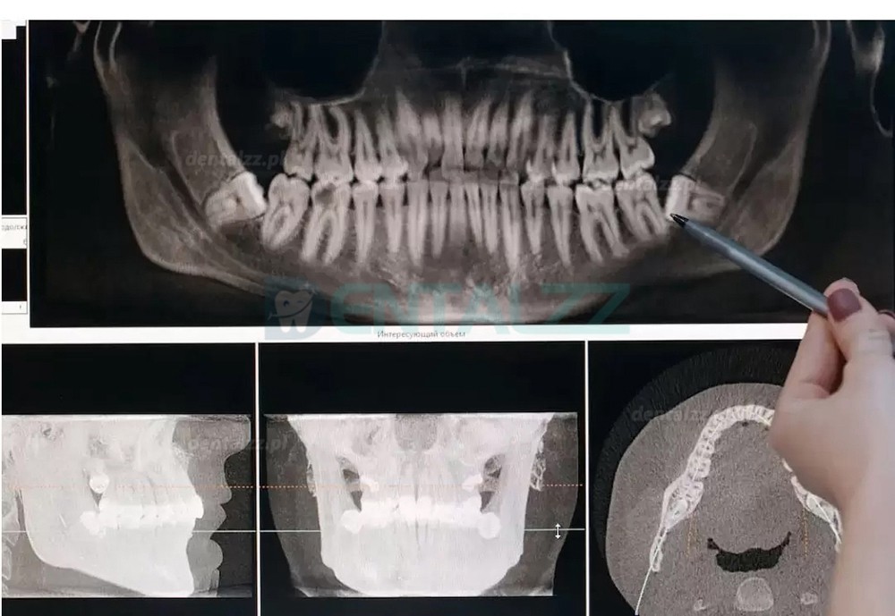 Refine MaxSurgery Urządzenie do piezochirurgii stomatologicznej ultradźwiękowy system piezochirurgii kości