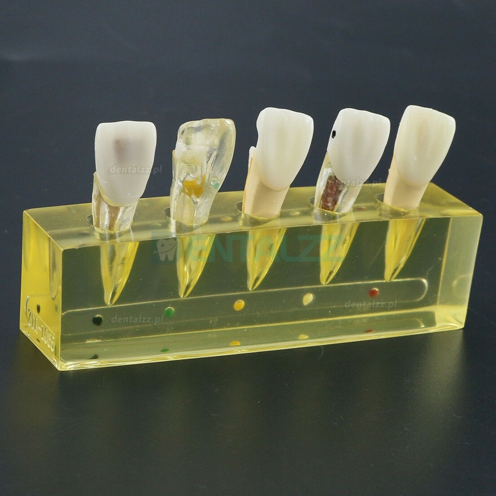 Model zębów dentystycznych 5 etapów Demonstracja Leczenie endodontyczne Siekacz kanału korzeniowego