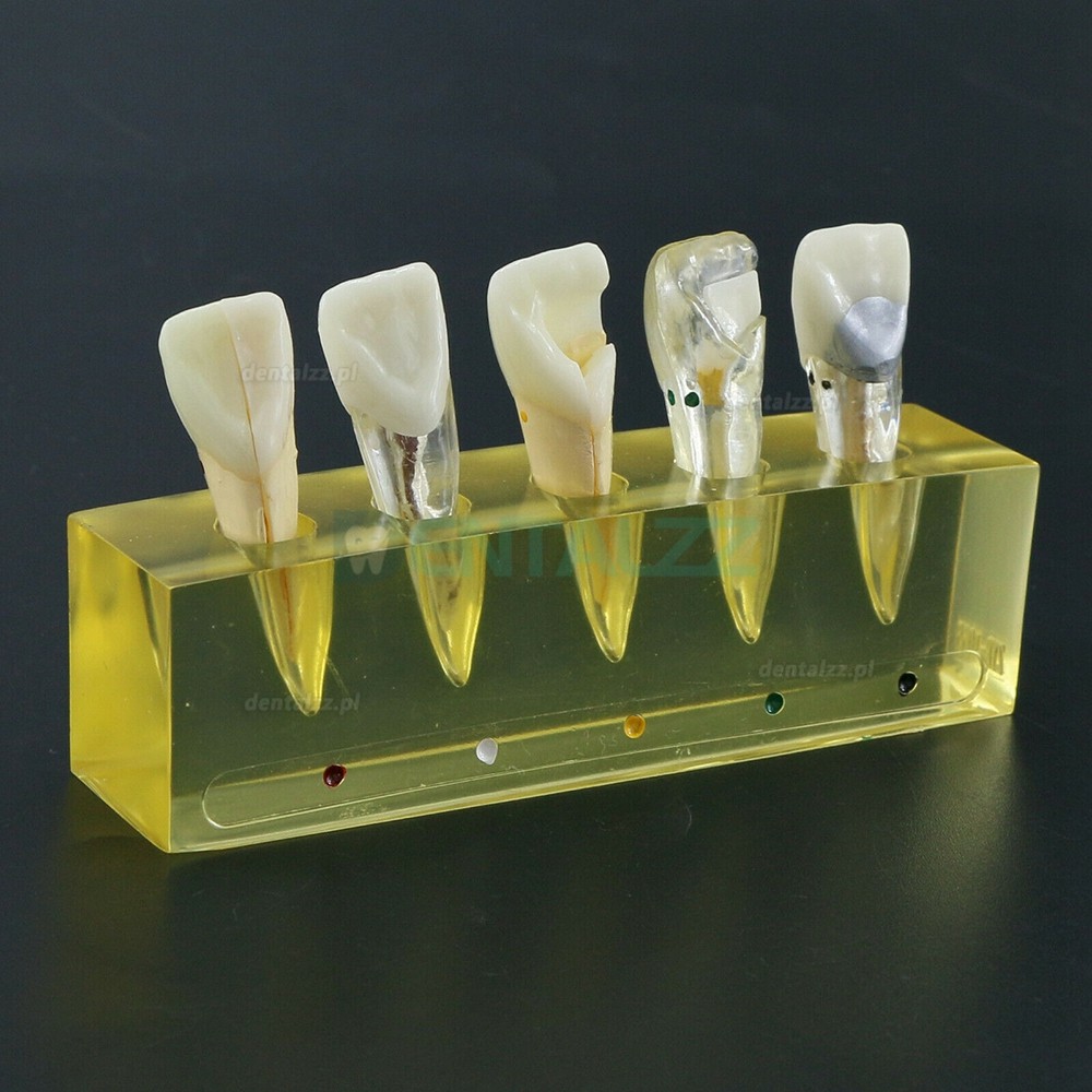 Model zębów dentystycznych 5 etapów Demonstracja Leczenie endodontyczne Siekacz kanału korzeniowego