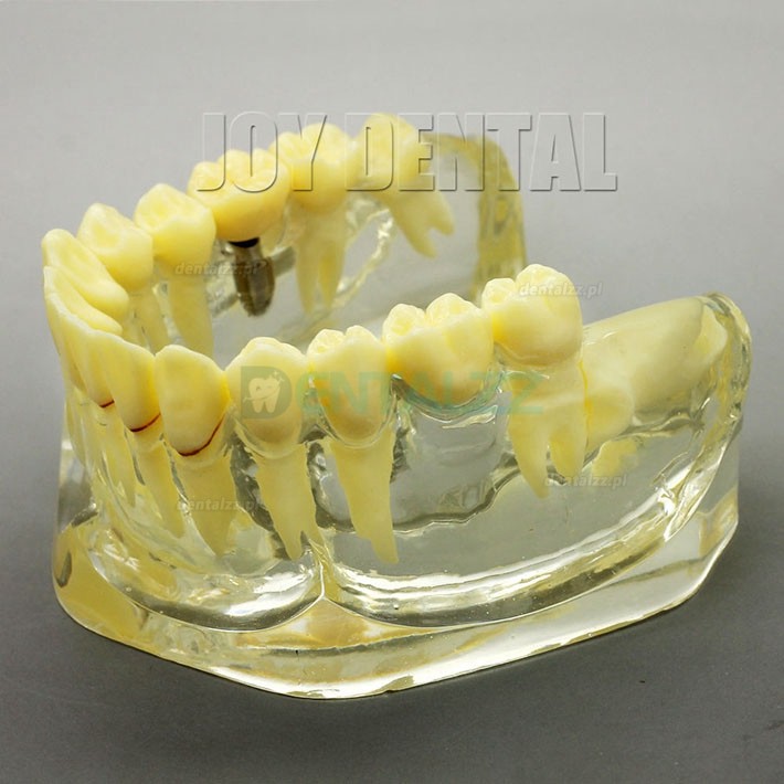 2 Razy powiększony model badania odbudowy zębów/protezy/implantu z mostem