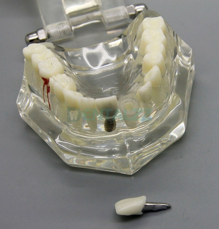 Analiza badania implantów dentystycznych Demonstracja modelu choroby zębów z odbudową M2001