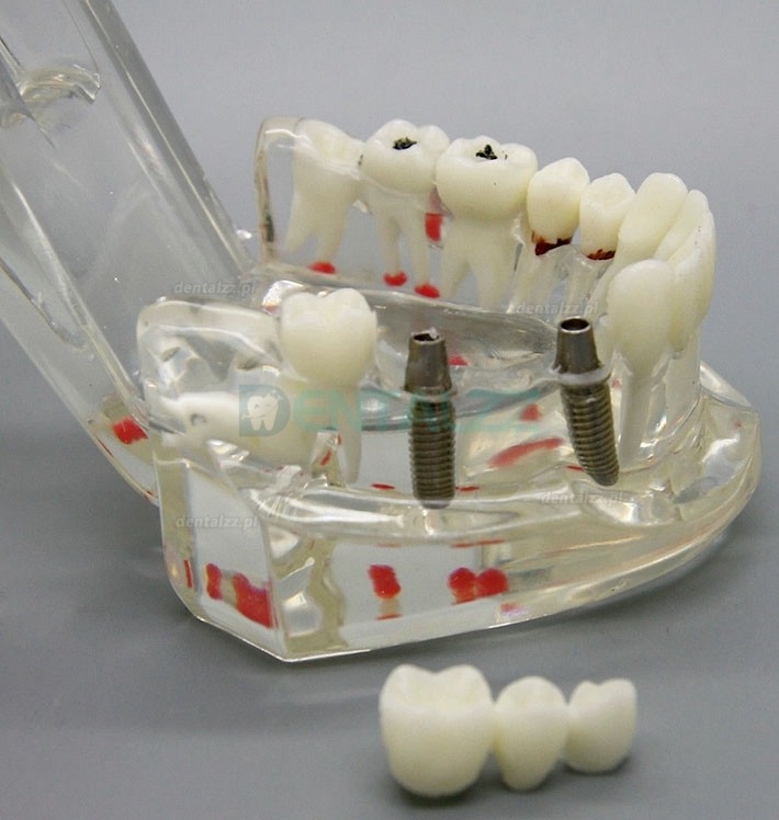 Analiza badania implantów dentystycznych Demonstracja modelu choroby zębów z odbudową M2001