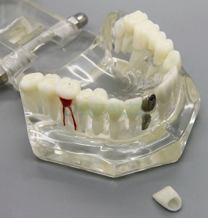 Analiza badania implantów dentystycznych Demonstracja modelu choroby zębów z odbudową M2001